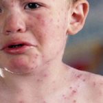 Penyakit Campak dan Rubella Berdampak Cacat Permanen pada Anak