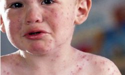 Penyakit Campak dan Rubella Berdampak Cacat Permanen pada Anak