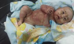 Dokter RSUD Nunukan: Bayi yang Kulit melepuh Menderita Penyakit Dermatitis