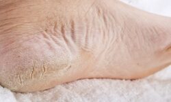 Mengatasi Telapak Kaki yang Pecah-pecah