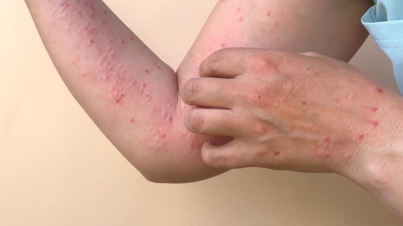 Kasus Monkeypox Bertambah di Indonesia karena Seks Berisiko - Niaga.Asia