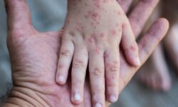 Kemenkes Catat Penurunan Kasus Campak