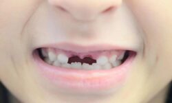 Bahaya Gigi Ompong Dibiarkan Terlalu Lama