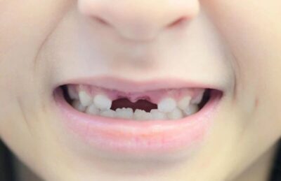 Bahaya Gigi Ompong Dibiarkan Terlalu Lama