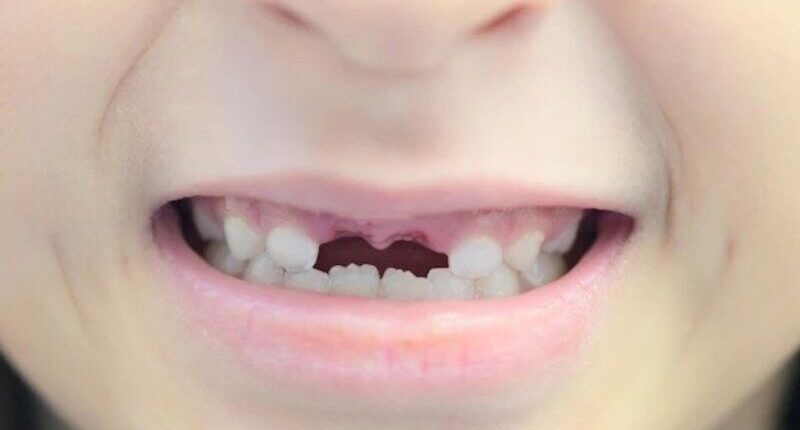 Bahaya Gigi Ompong Dibiarkan Terlalu Lama